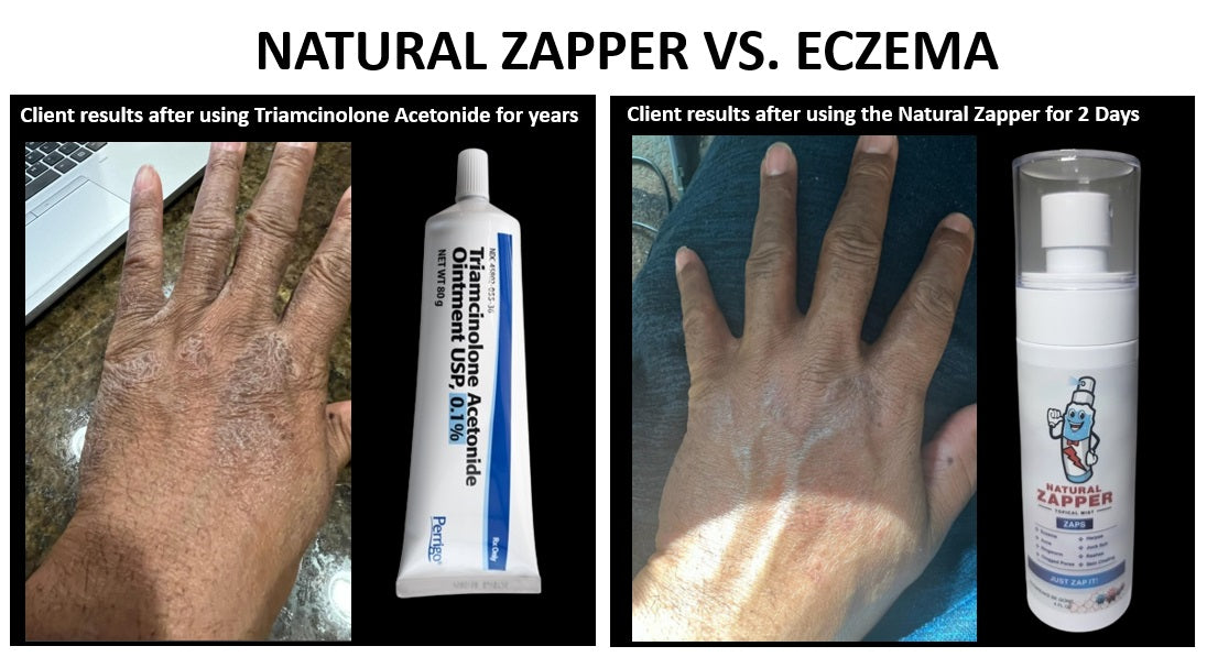 Natural Zapper Topical Mist